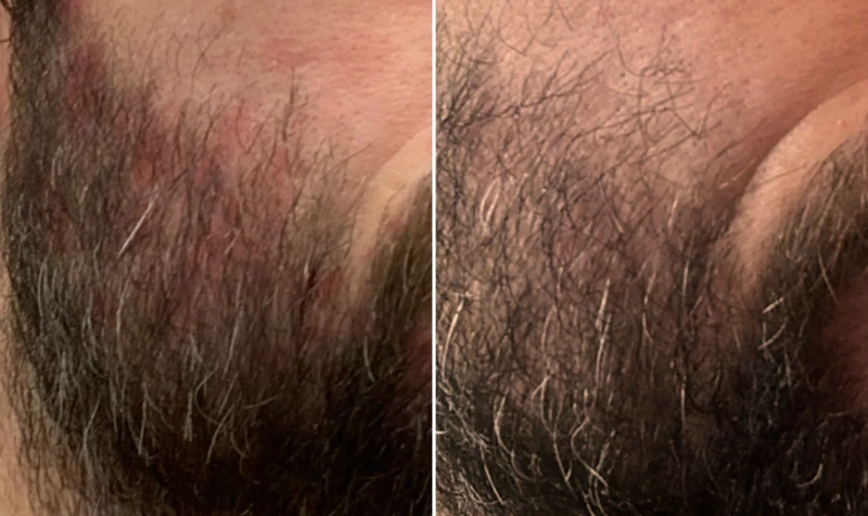 eczema